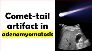 Comet ☄️ tail artifact in adenomyomatosis [upl. by Somerset]