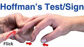 How to Perform a Hoffmans Test  Inverted Supinator Sign  Clonus  Hyperreflexia [upl. by Lutim]