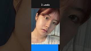 Double Jaw Surgery in Korea Before amp After 3 months post op [upl. by Verdha]