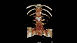 L45 spondylolytic spondylolisthesis [upl. by Fillbert794]