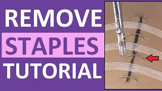 Surgical Staple Removal Nursing  How to Remove Surgical Staples [upl. by Aehs]