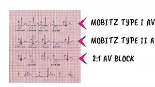 VARIABLE PR INTERVAL [upl. by Erait]