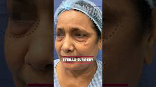 Before and After result Under eyebags removal with blepharoplasty  Eyebags removal surgery [upl. by Treacy]