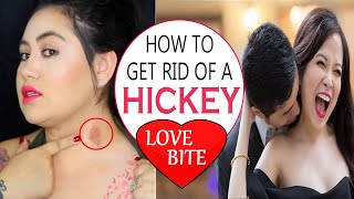 How to Get Rid of a Hickey Fast  Home Remedies for Love Bite Removal  Remove Hickey Fast [upl. by Underwood]