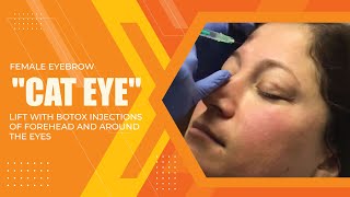 FEMALE EYEBROW quotCAT EYEquot LIFT WITH BOTOX INJECTIONS OF FOREHEAD AND AROUND THE EYES  Dr Jason Emer [upl. by Jagir211]