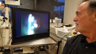 Eye Floater Treatment with Laser patient of Scott Geller MD [upl. by Nhabois]