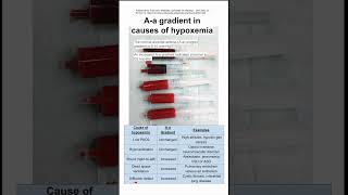 Aa gradient hypoxemia [upl. by Dis]