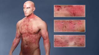 Atopic Dermatitis eczema From the Inside Out [upl. by Alden]