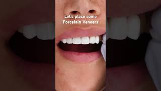 Placing Porcelain Veneers porcelainveneers smiledentist dentist smile [upl. by Poree]