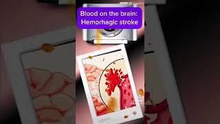 Hemorrhagic stroke occurs when a blood vessel in the brain ruptures Stroke EmergencyResponse [upl. by Akinoj12]