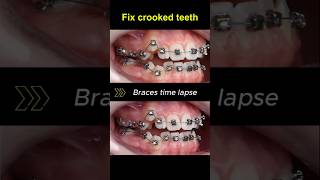 Braces for crooked teeth transformation before and after braces orthodontist dentist bracket [upl. by Ojeibbob]