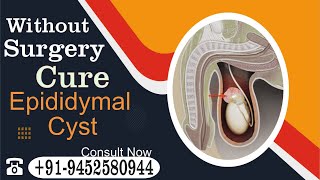 How do you get rid of an epididymal cyst naturally Know by Dr Nizamuddin Qasmi sir [upl. by Aroon]