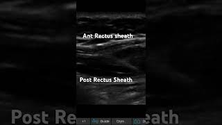 RECTUS SHEATH BLOCK IN LONG AXIS [upl. by Hamachi]