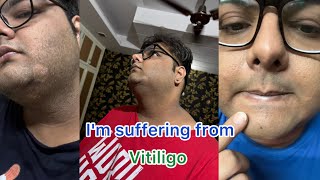 Im suffering from Vitiligo  Weightloss Problem  Weight Loss Journey [upl. by Westlund223]