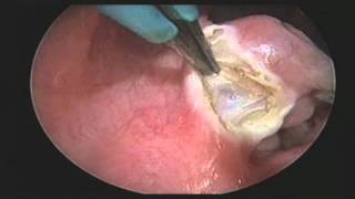 ENT Tonsillectomy with QMR Vesalius Device [upl. by Rivers]