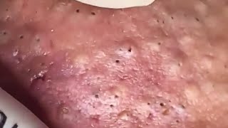 Blackheads amp Whiteheads Satisfying Removal 0275 [upl. by Shirley302]