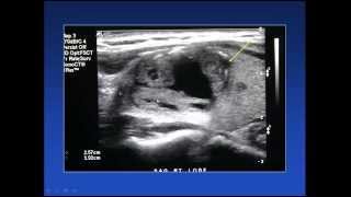 2015 AOCR Radiology Case Review Thyroid Ultrasound [upl. by Utham]