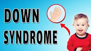 Down Syndrome Features [upl. by Soalokcin]