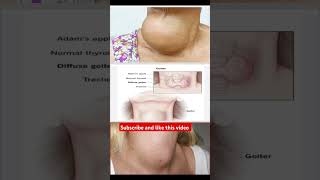 Goiter disease lack of iodine drugeducation medicalstudent [upl. by Gersham]