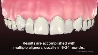 ClearPath Aligners  NEW VIDEO for PATIENT EDUCATION by AACD [upl. by Soalokcin]