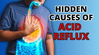 5 Hidden Causes of Acid Reflux You Need to Know [upl. by Ayr]