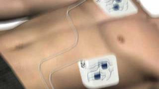 How to use an AED automated external defibrillator [upl. by Llacam]