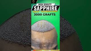 HairTransplant sapphire HairTransformation HairJourney HairGrowth BeforeAndAfter NewHair [upl. by Gahan]