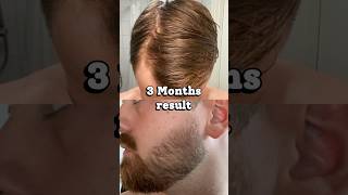 This is what derma rolling and minoxidil did to my hair and beard in 3 months [upl. by Jecoa]