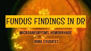 DIABETIC RETINOPATHY clinical findings  Microaneurysms hemorrhage irma hardexudates and more [upl. by Lucia]