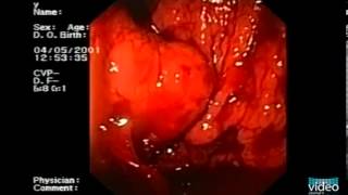 Endotherapy of Gastric Fundal Varices IntraVariceal Injection of NButyl2Cyanoacrylate [upl. by Akirre677]