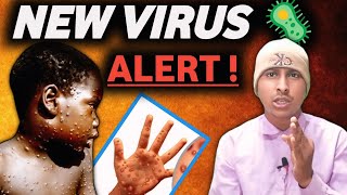 Monkey Pox Virus A Growing Public Health Threat  Explain Video  Vivek Bind [upl. by Rebmat]