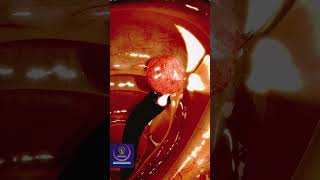 Colon Polyp Removal  3D Animation [upl. by Annahoj]