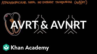 Atrioventricular reentrant tachycardia AVRT amp AV nodal reentrant tachycardia AVNRT [upl. by Inuat]