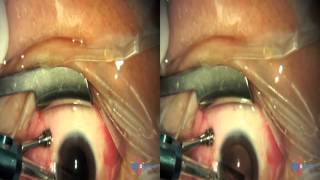 Pars Plana Vitrectomy PPV  Phacoemulsification Phaco [upl. by Werra]