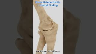 Discover The Root Of Elbow Pain Osteoarthritis Uncovered [upl. by Imugem476]