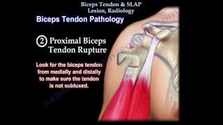 Biceps Tendon amp SLAP Lesion Radiology  Everything You Need To Know  Dr Nabil Ebraheim [upl. by Ger]