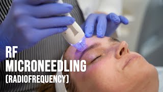 RF Radiofrequency Microneedling  Bonnie Brenkman Medical Aesthetician  West End Plastic Surgery [upl. by Warila]