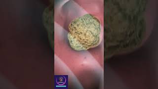 Kidney Stones Demolished  Treatment With Shock Wave Lithotripsy [upl. by Aicat]