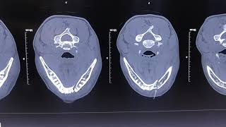 Mandibular Body Fracture  Open Reduction Internal Reduction [upl. by Adnol]