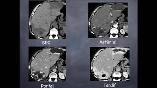 Tumeurs du foie  Bénignes  3 Hémangiome hépatique [upl. by Ibrik]