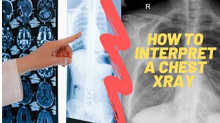 How to read a Chest Xray For medical students residents and clinicians [upl. by Douglas]