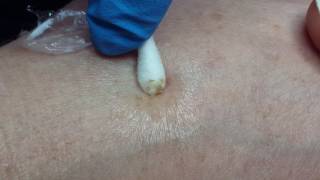 LAMPROBE removal of Age spot on hand by Janine Thomson [upl. by Colville]