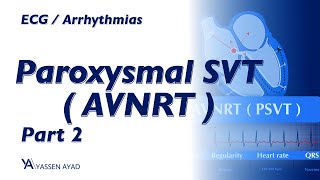 ECG 53  AVNRT  SVT  2 [upl. by Burnley]