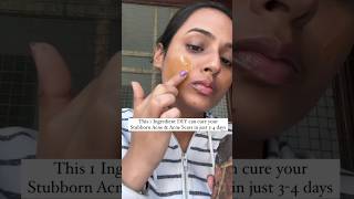 Acne Treatment at home  Remove Acne amp Acne Scars at home  Pimples treatment at home acnetreatment [upl. by Tertia]