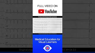 Tachycardiabradycardia syndrome ECG shorts [upl. by Jules]