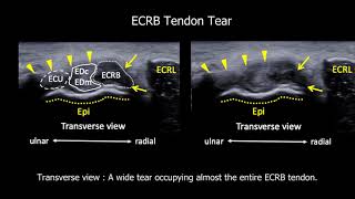 Adding a Transverse Scan in the Ultrasound Diagnosis of Extensor Tendinopathy [upl. by Lua776]