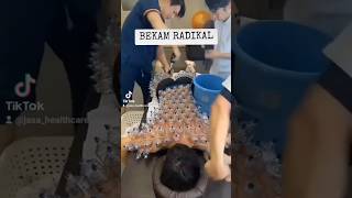 Bekam Radikal bekam cupping healthcare wellness shorts viralshorts [upl. by Enihpad]