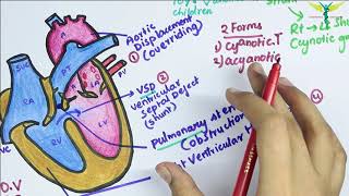 Tetralogy of Fallot TOF [upl. by Dikmen31]