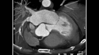 Cardiac Coronary anatomy 3 of 3 [upl. by Eppie]