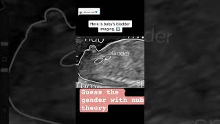 Guess the gender with nub theorybaby boy pregnancycare pregnancy ultrasound [upl. by Wallach]